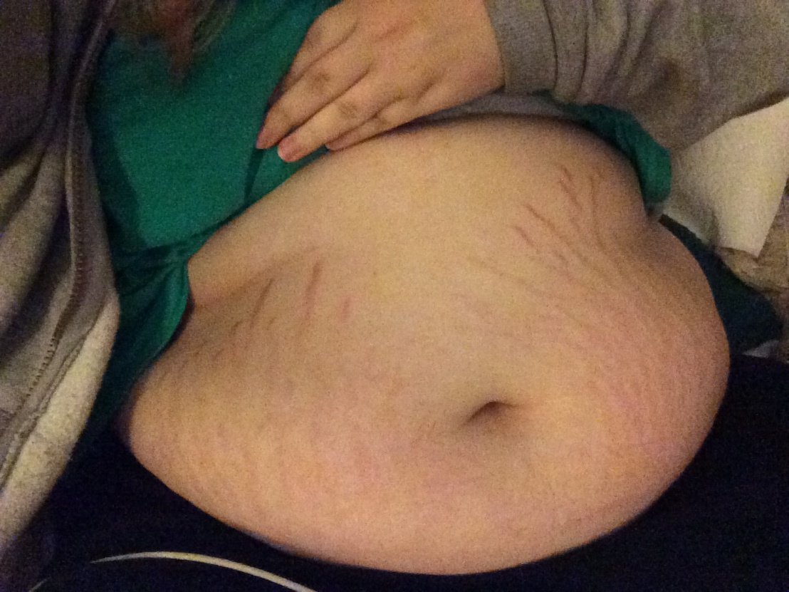 154054432474 - 01 - New stretch marks coming in.jpg