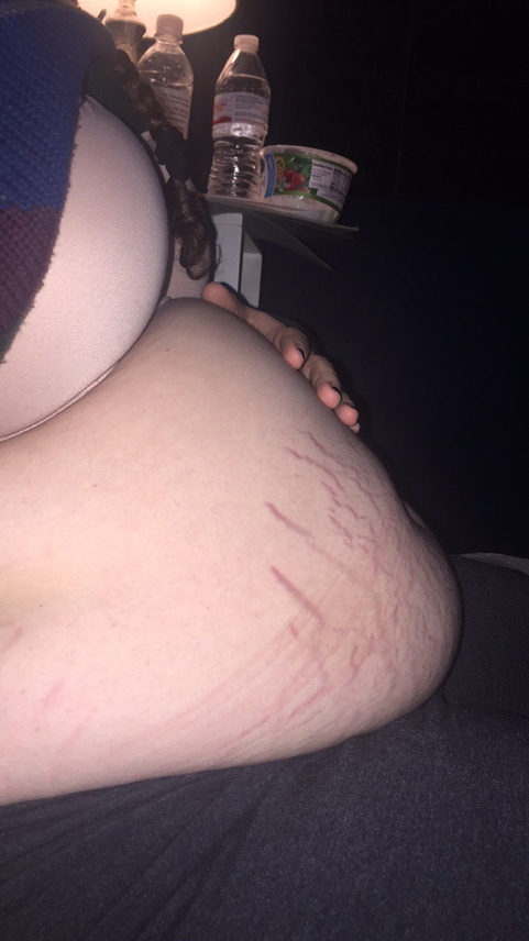 153502799975 stretch marks galore ive been feeling_3.jpg