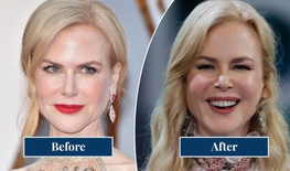 nicole-kidman-before-and-after-pillow-face